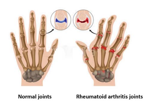 Anti-CCP, lampada a segnale per Rheumatoide Artrite